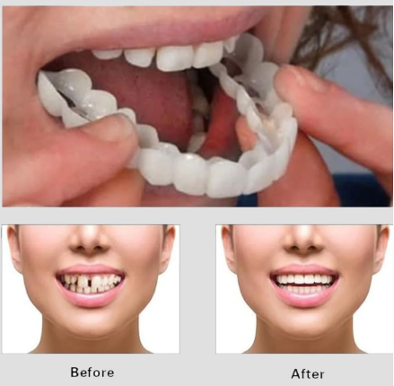Snap On Smile - Instant Cosmetic Teeth Veneer