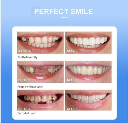 Snap On Smile - Instant Cosmetic Teeth Veneer